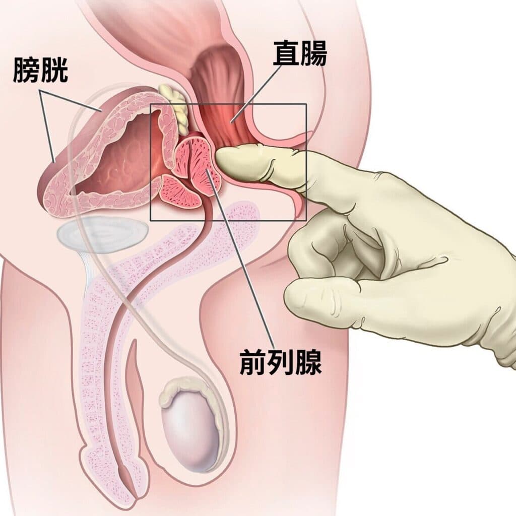 S__108961894_0 前列腺高潮